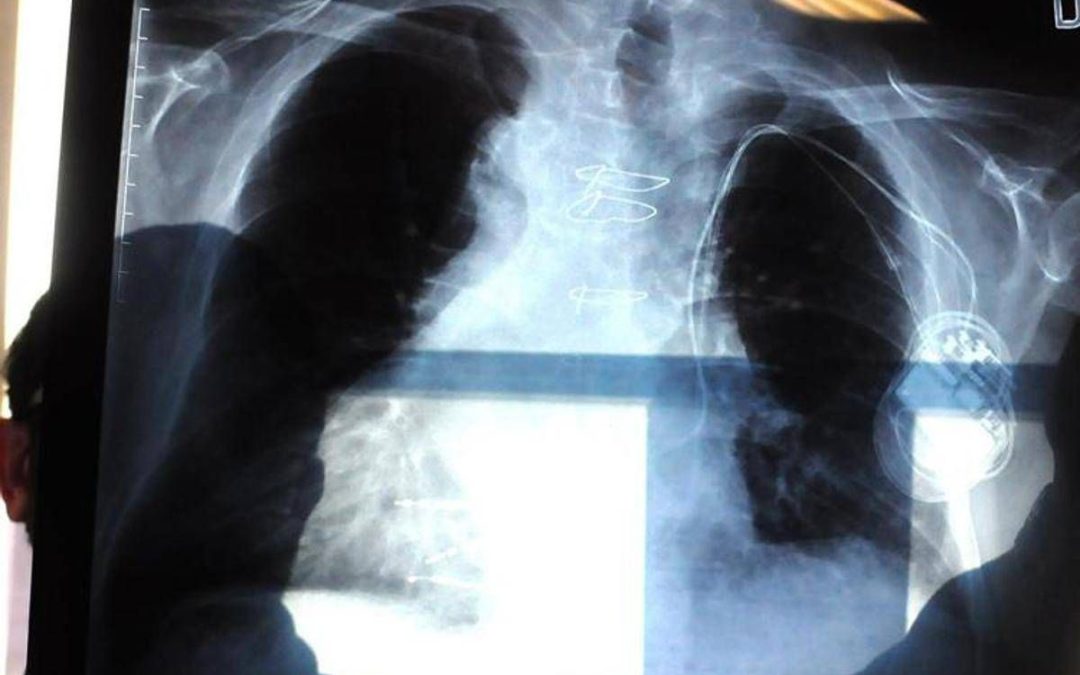 Polmonite, ogni anno in Italia 150mila ricoveri e 9mila morti: i sintomi