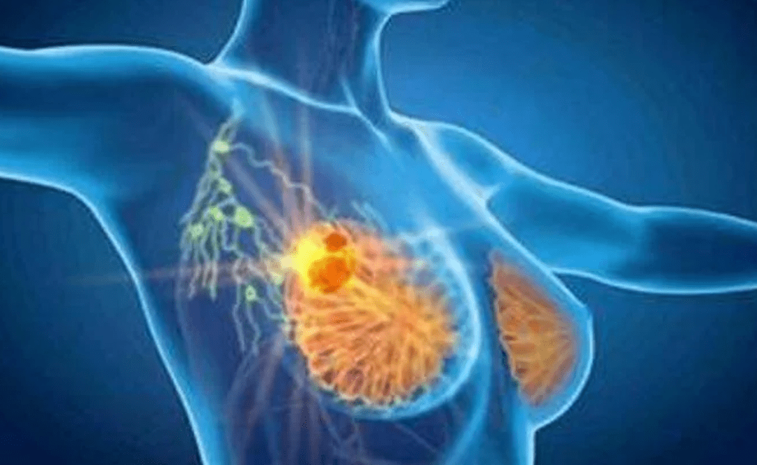 Cancro seno, con profilazione molecolare e terapie target migliori prospettive di cura