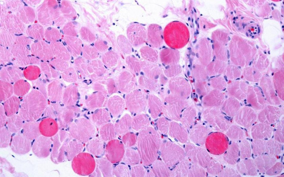 Malattie rare, risultati positivi a 5 anni per vamorolone in distrofia Duchenne