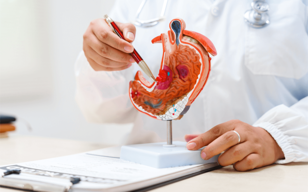 Tumore allo stomaco, pazienti: “Diagnosi precoce per meno di 1 su 5, migliorare percorsi”