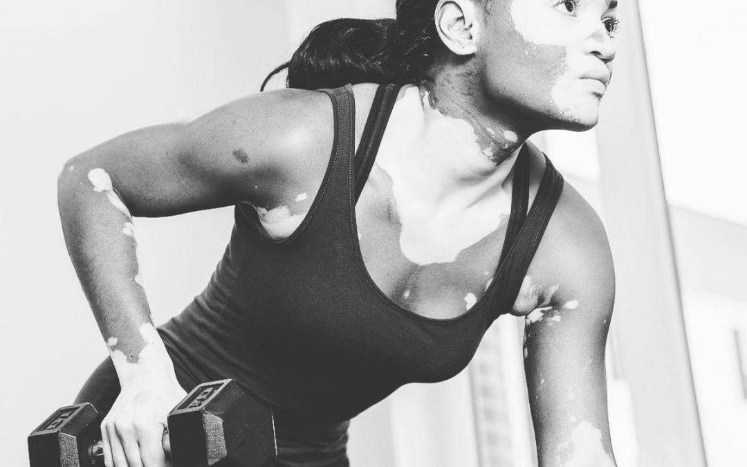 Vitiligine, “così la terapia della luce aiuta il farmaco”