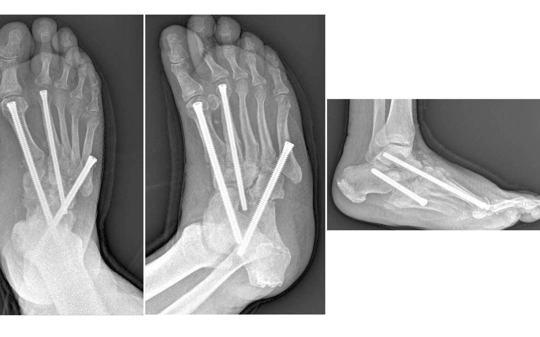 Piede di Charcot, al Gemelli soluzioni avanzate per una complicanza rara del diabete