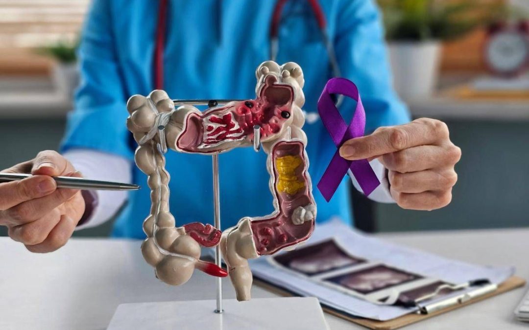 Tumori del colon retto, Int Milano in progetto Ue che punta a prevedere efficacia immunoterapia