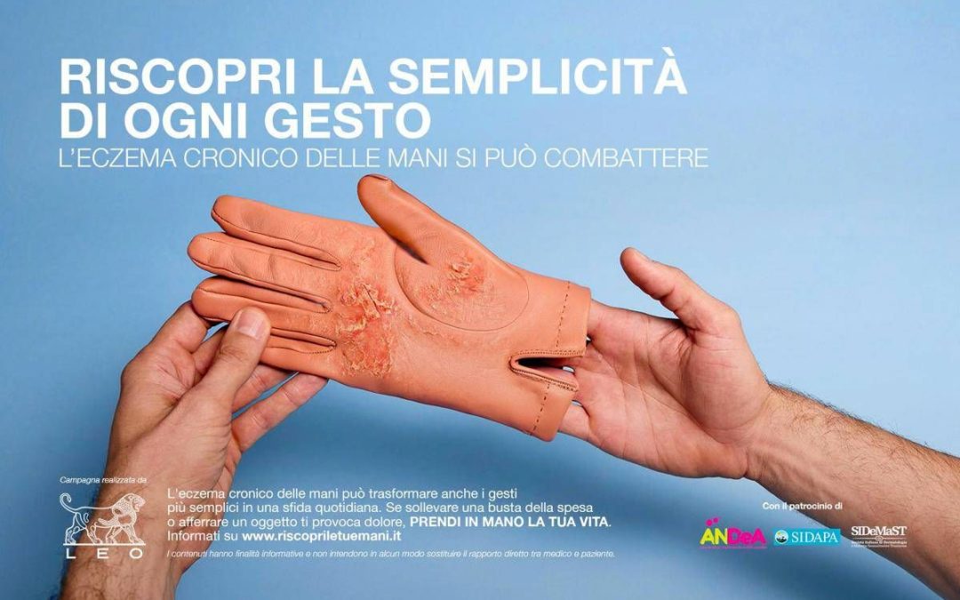 Mani che bruciano e fanno male, al via campagna su eczema cronico