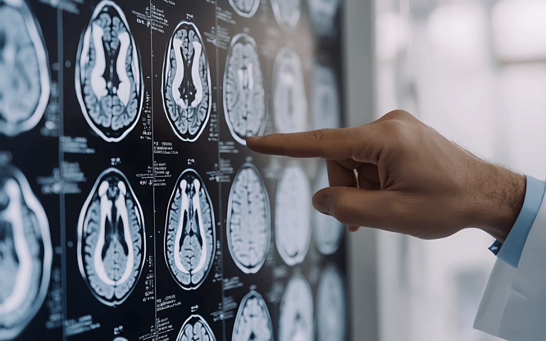 Parkinson, ansia e depressione possono essere segnali precoci: lo studio